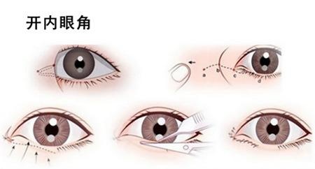 什么是双眼皮手术 69cdb68f39894b1a9cecec51c01b3454.jpeg