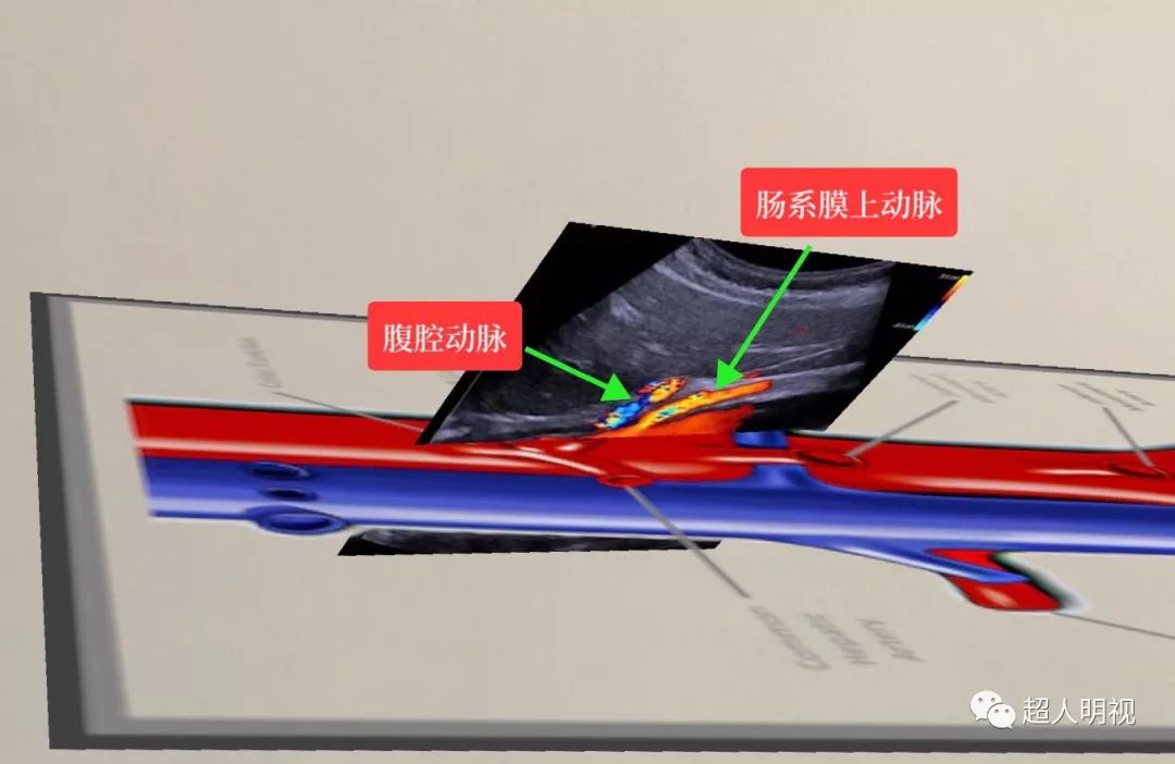 腹部血管超声图像与解剖图融合