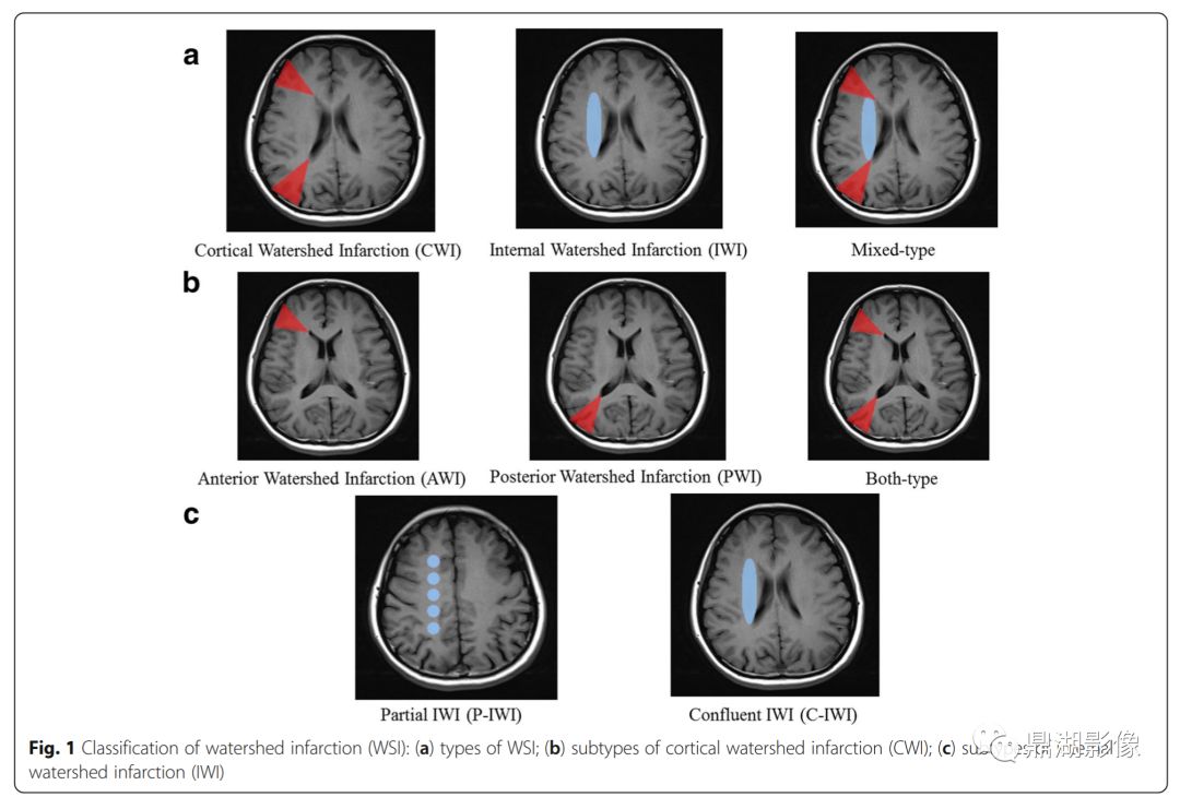 可分为: 部分iwi(p-iwi,即半卵圆中心的单一或串珠状梗死)和 连续iwi