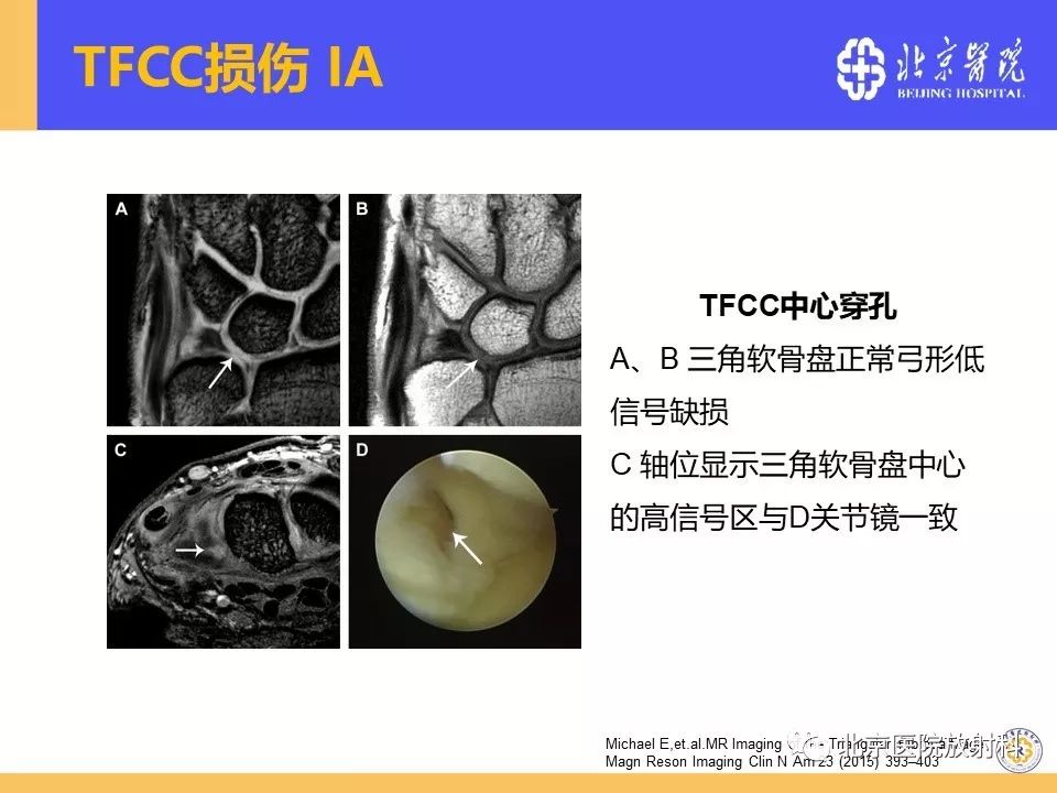 推荐| 三角纤维软骨复合体(tfcc)损伤