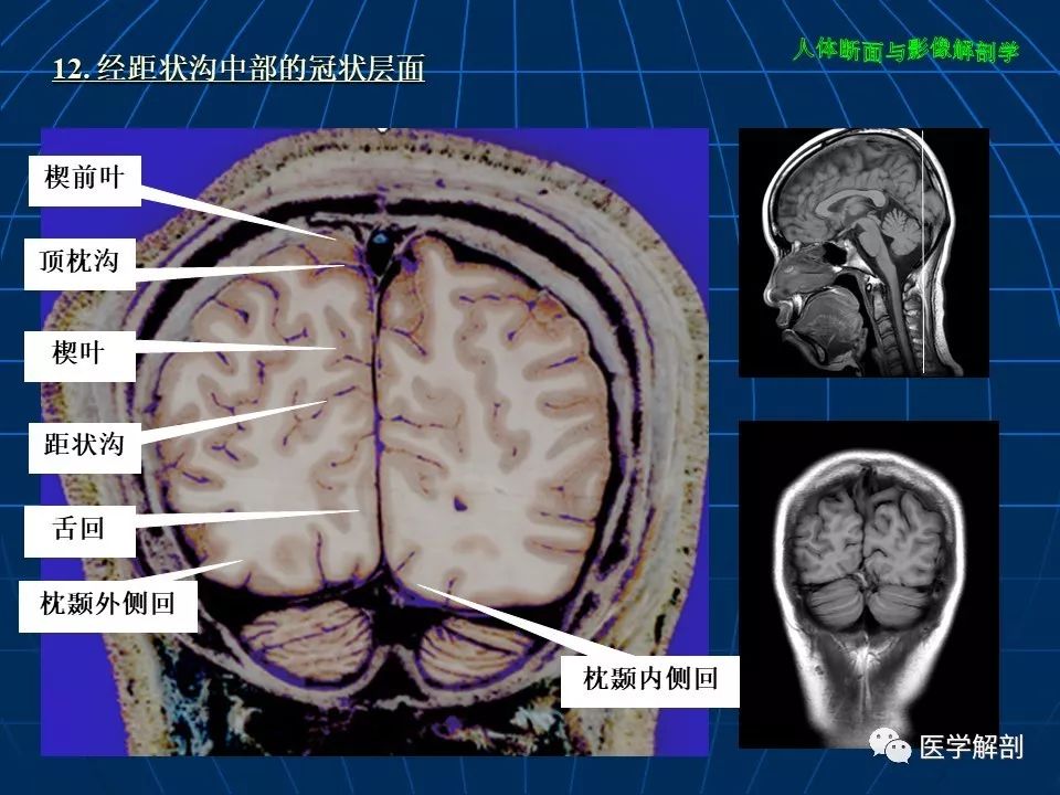 颅脑大体断层解剖(冠状位)