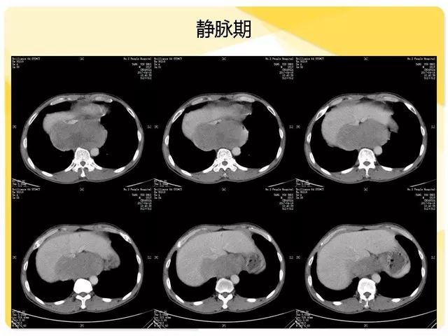 异位胸腺瘤,等你分析丨读片专栏1184期