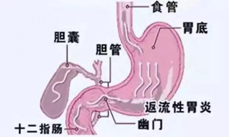 胃一直胀气居然是胆汁返流这是什么病应该怎么治疗