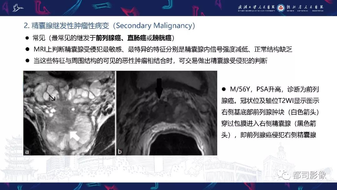 精囊腺病变mri表现