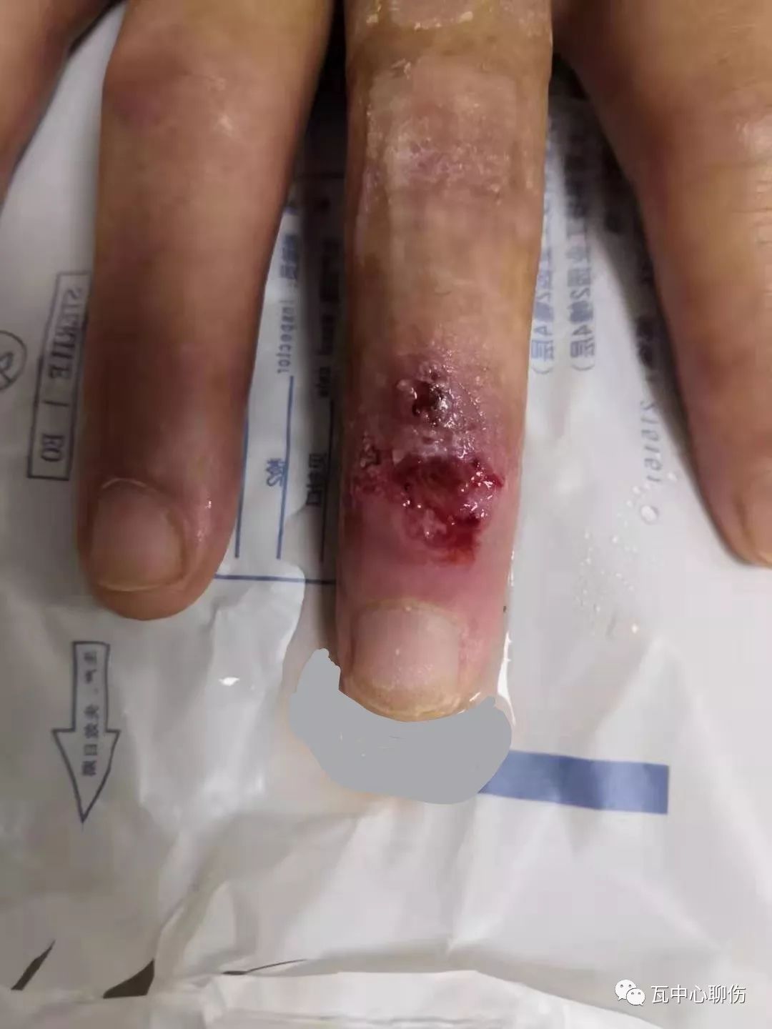 手指关节外伤后感染伴关节液外漏案例分享-德维可,葆湿曼,德敷等综合