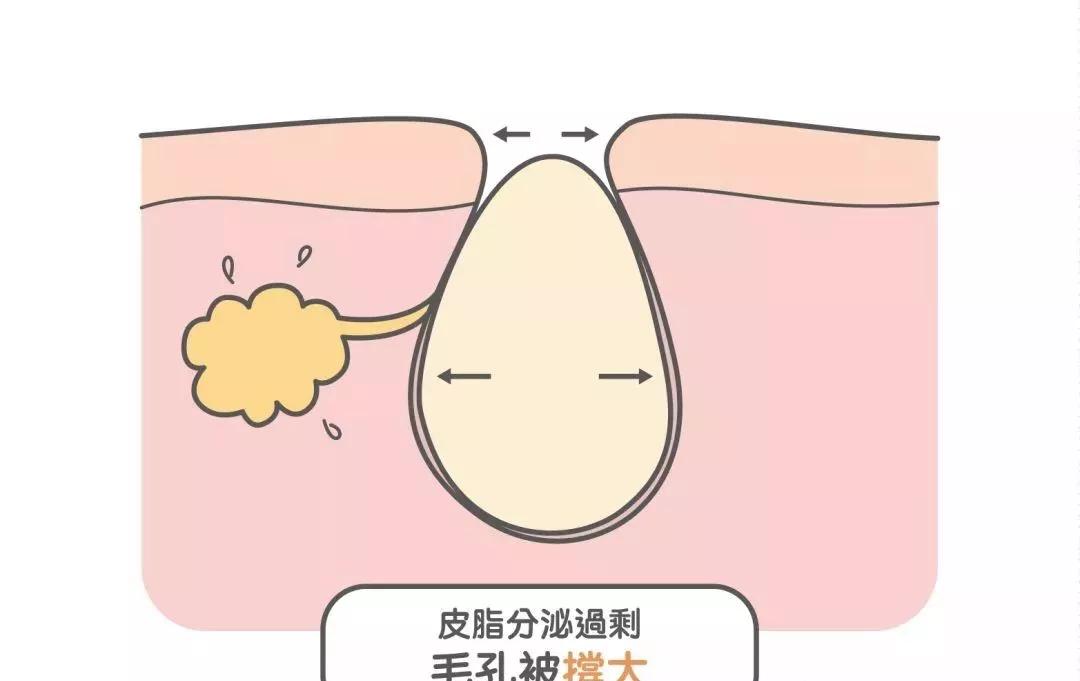 注重清洁控油的人,为什么毛孔依旧越来越大?_皮肤