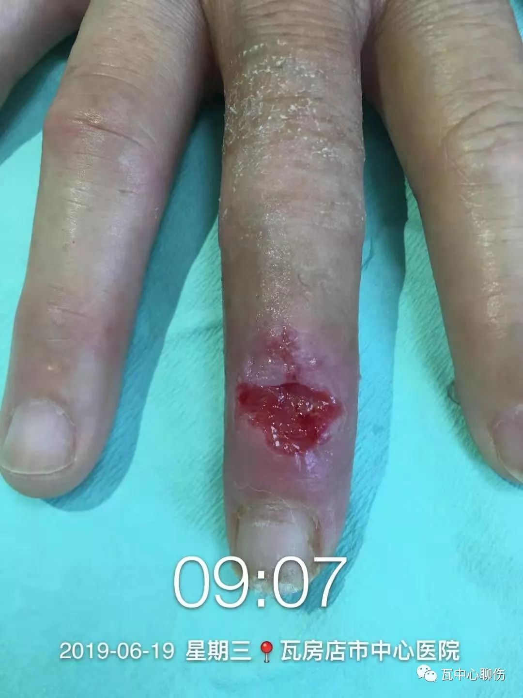 深达关节腔,基底炎性肉芽,手指水肿,x线检查中指骨骼无异常,伤口分泌