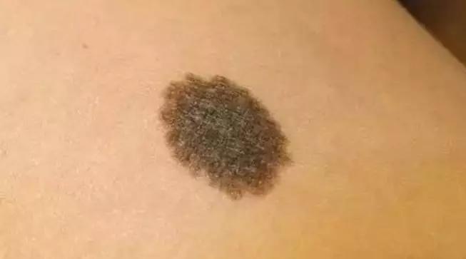                     半岁宝宝胎记癌变！若娃身上有这6种斑或痣，父母一定要警惕！