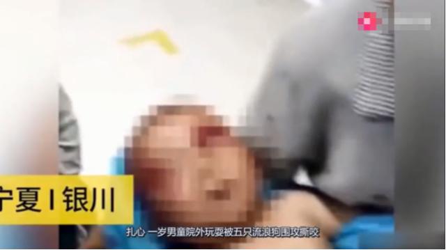                     1岁男童遭5只流浪狗撕咬拖拽，全身80%咬伤，眼睑撕裂