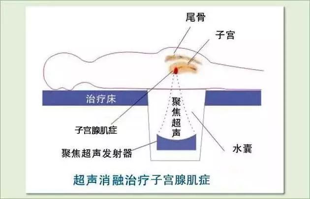 海扶刀-曾经害怕被骗,如今赶来代言