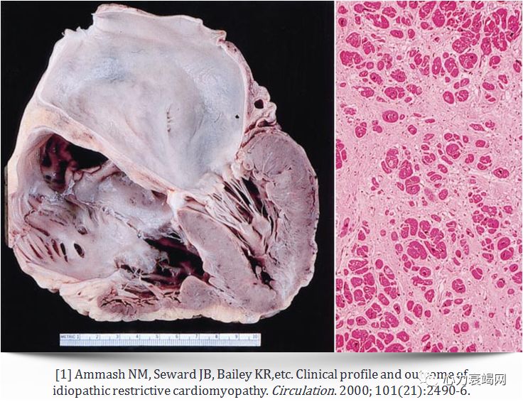 【病例分享】朱小刚:特发性限制性心肌病一例