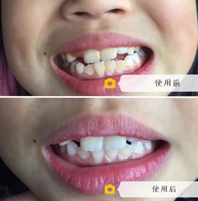 几个月出牙几岁换牙 f6c5aef38c1849d1887a003d97e02f75.jpeg