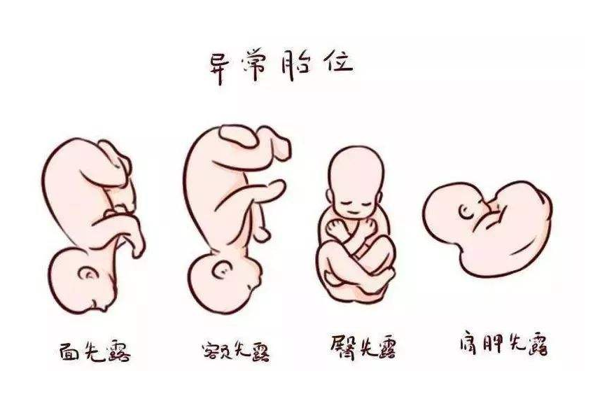 额位:当胎头呈不完全仰伸姿势时,额头部位将成为胎儿的先露部.