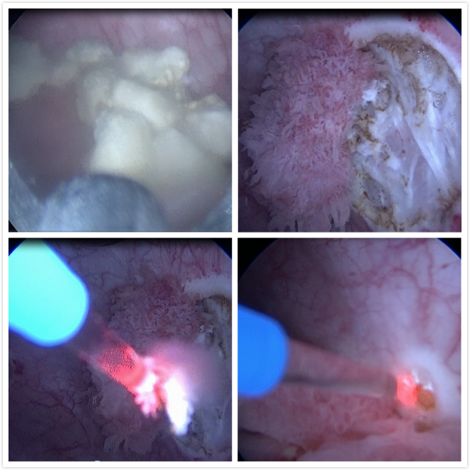更精准更微创治疗膀胱肿瘤--经尿道膀胱肿瘤激光整块切除术