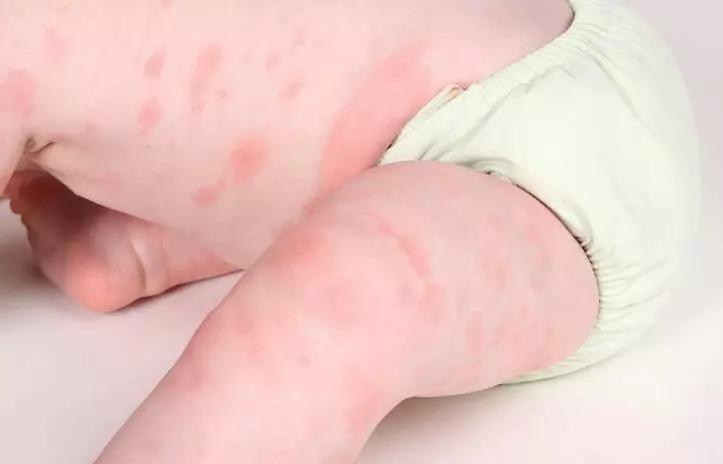 宝宝的皮肤干燥出现了红肿,红斑,经常抓痒,妈妈一定要带宝宝及时就医
