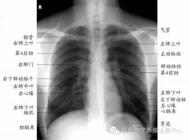 读胸片六大要素,您了解吗_肋骨