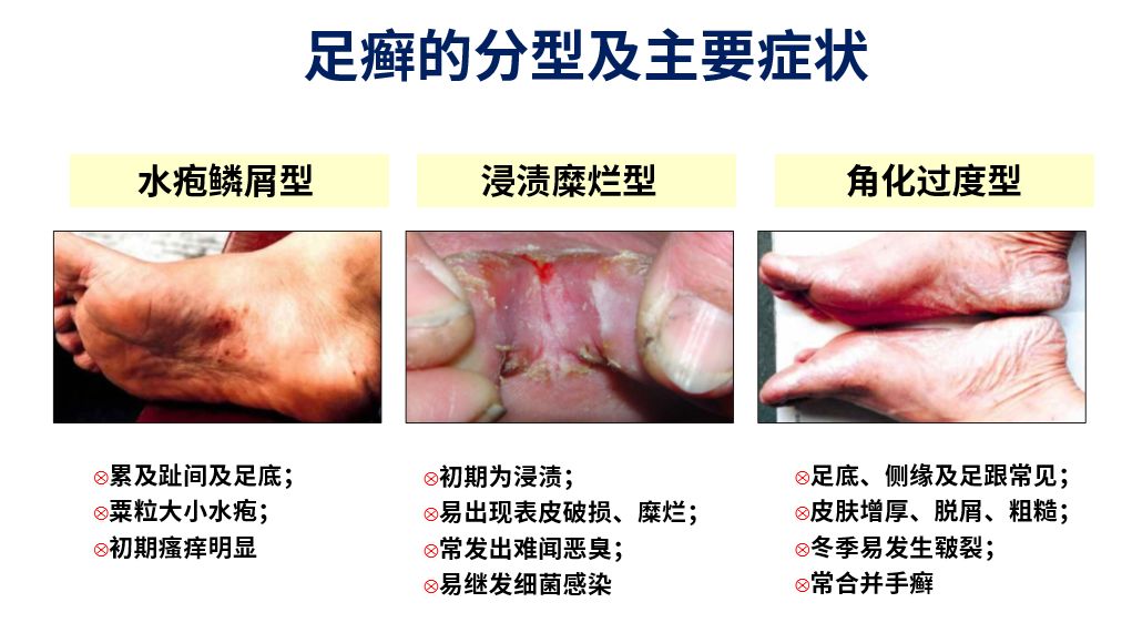 足癣常可分为三型(图 1:水疱鳞屑型,浸渍糜烂型和角化过度型.