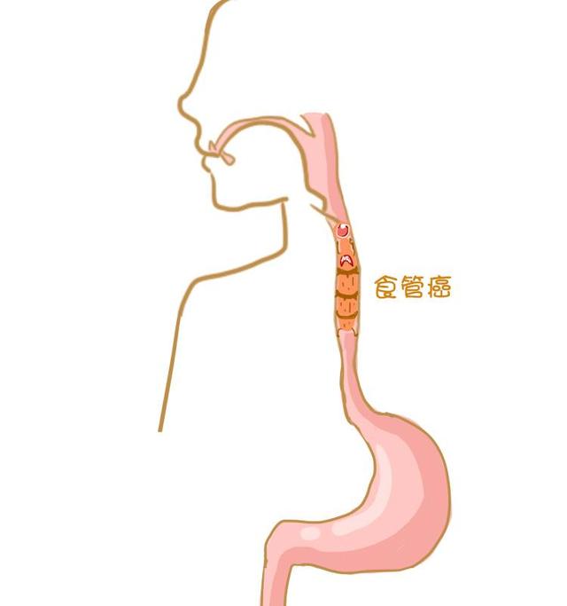 食道黏膜正常耐受温度在40℃~50℃,超过这一范围就容易发生损伤,造成