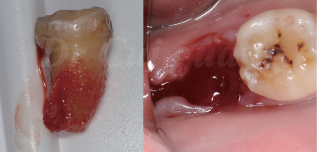 后,发现有大量肉芽存在,认真搔刮牙槽窝图9 缝合的目的是尽量缩小拔牙