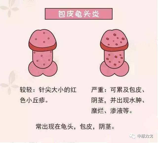 龟头炎危害,别让龟头炎侵害男性健康!