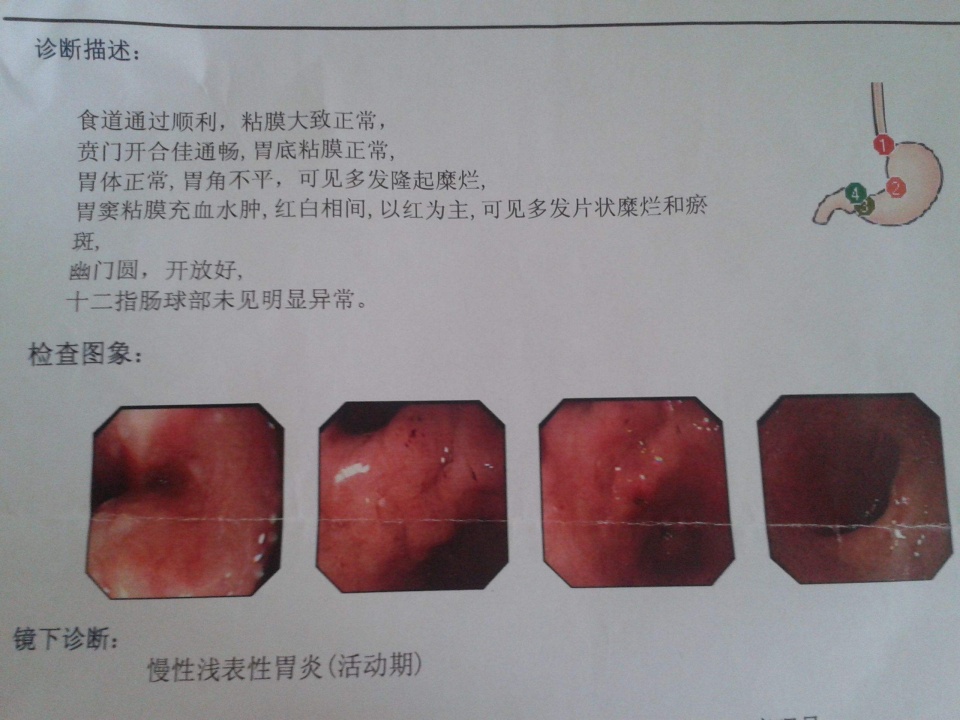 6,糜烂浅表性胃炎可出现黏膜糜烂,黏膜上皮完整性受损,表层黏膜剥脱