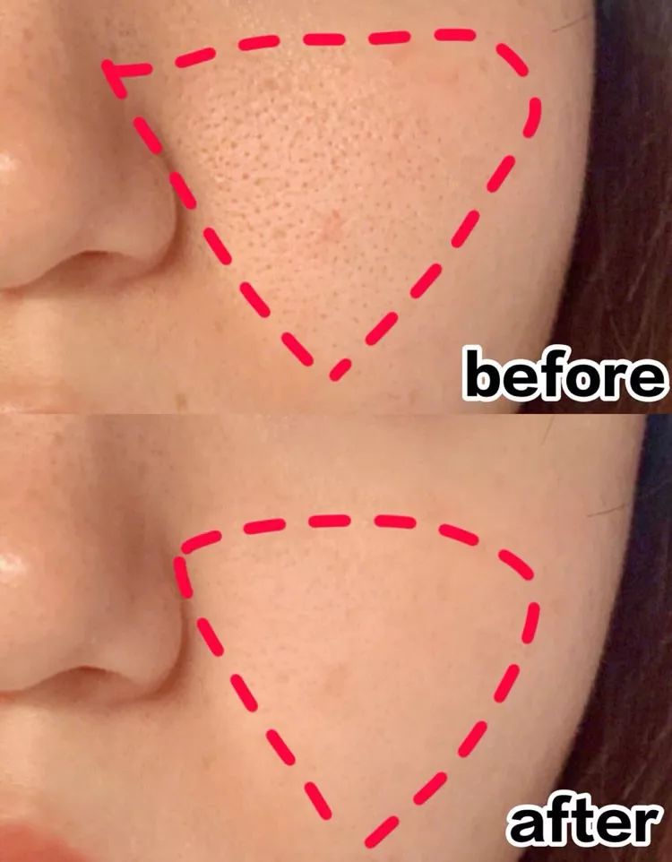 什么是黑头和粉刺闭口 c1acab3a2ae043f79b9a15c4693a060c.jpeg