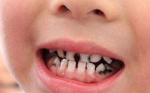 为什么牙齿总是容易变色~六安竹子口腔医院为你科普!