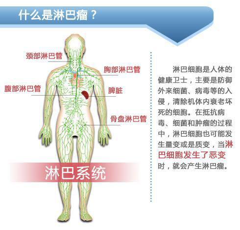 淋巴瘤 gdp_淋巴瘤早期症状图图片