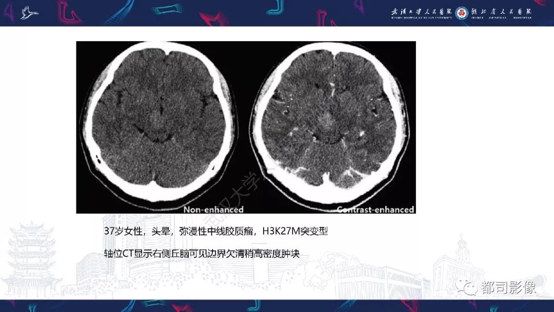 弥漫性中线胶质瘤影像诊断