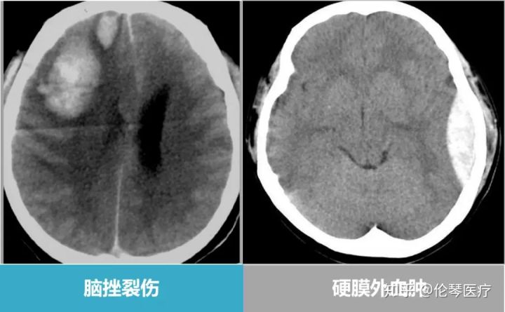 突发外伤以后,患者就医通过ct检查,可以显示患者脑出血,脑挫裂伤,颅骨