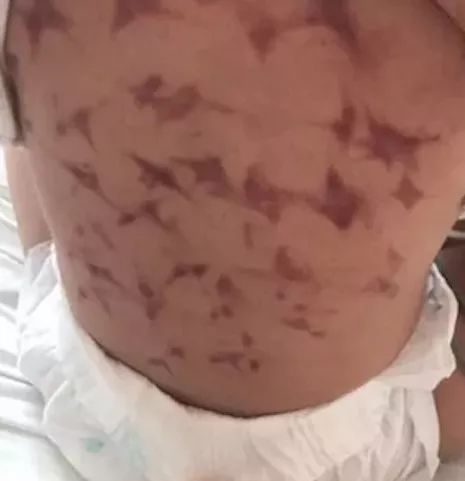                     惊了！厦门一女童骨折，爸爸让其“卧床百天”！结果...