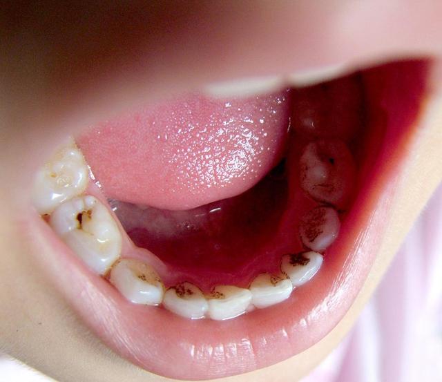 5岁娃牙齿全变"黑牙",罪魁祸首不是糖果,而家长却时常