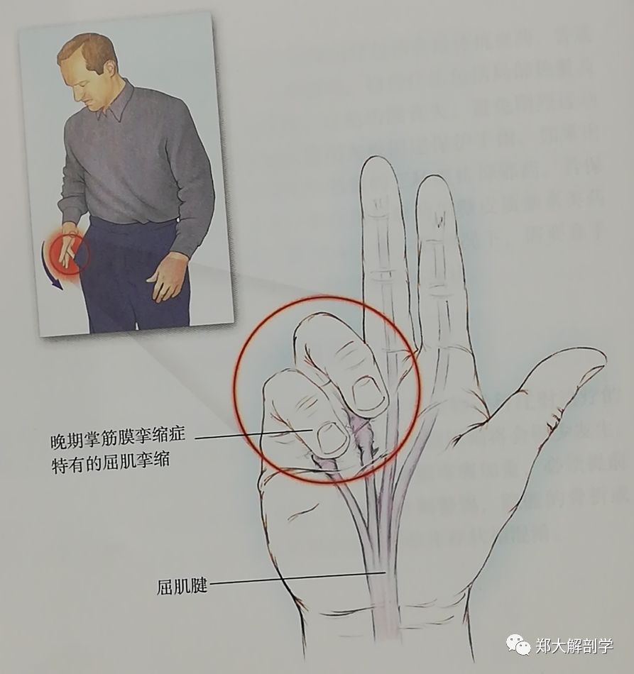 掌筋膜挛缩症通常累及40岁以上男性的无名指与小拇指在病程早期,沿着