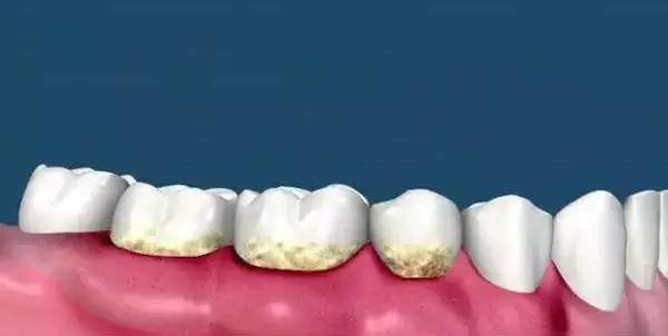 干扰细菌“交流”或能改善口腔健康，牙周病防治有了全新思路