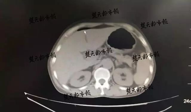                     惊了！厦门一女童骨折，爸爸让其“卧床百天”！结果...