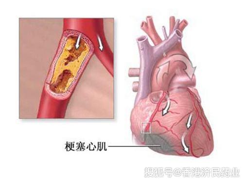 心梗,对健康产生的是致命性的伤害,如果出现以上征兆要警惕,尤其是