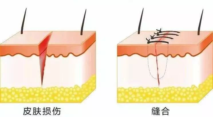 缝针伤口痒怎么办