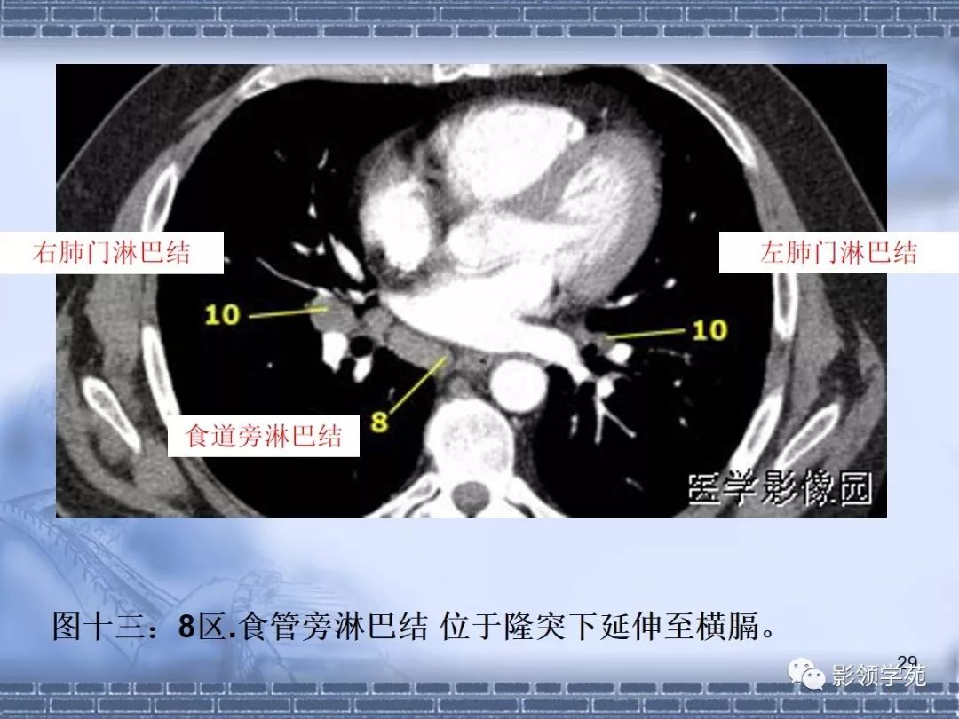 肺癌纵隔淋巴结分区