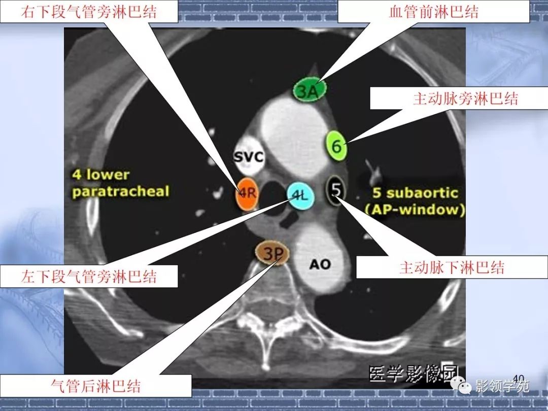 肺癌纵隔淋巴结分区