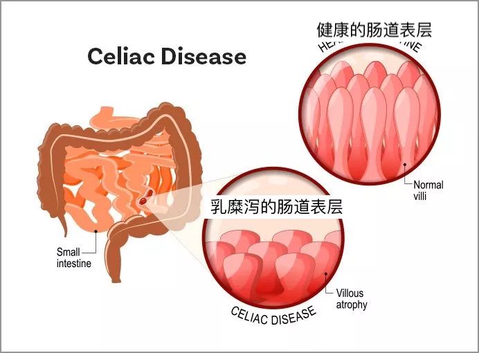 蔡依憬关注乳糜泻吃一点过敏食物真的没关系