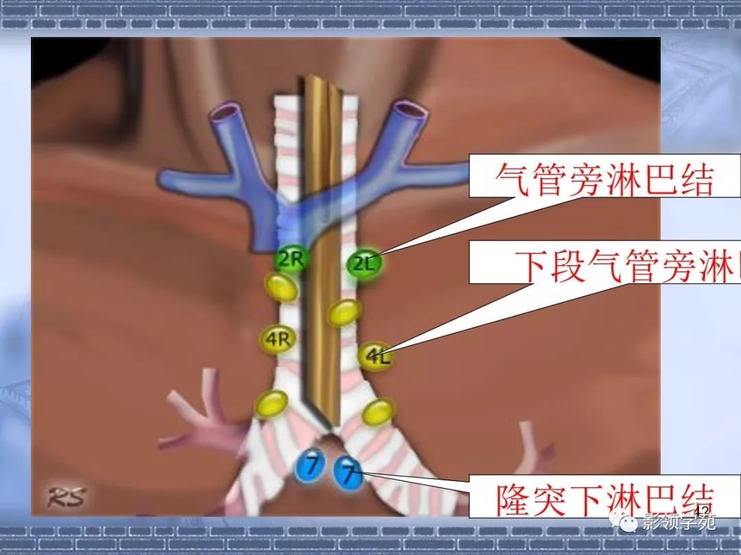 其上为上纵隔,该线以下至肺门下缘水平线之间为中纵隔,其下方至横膈