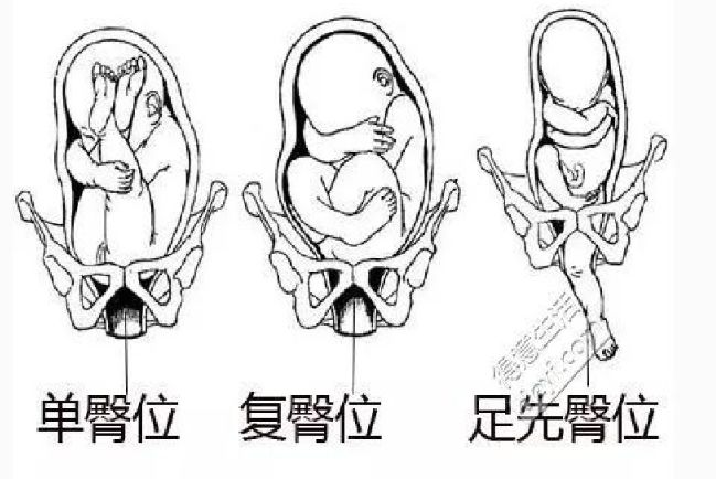 若失败则手术. 4)前不均倾:枕横位的特殊类型,需手术.