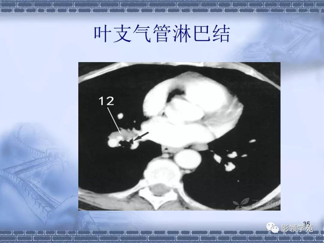 肺癌纵隔淋巴结分区