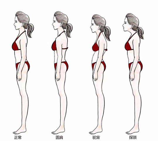 上交叉综合征的病因探讨及预防