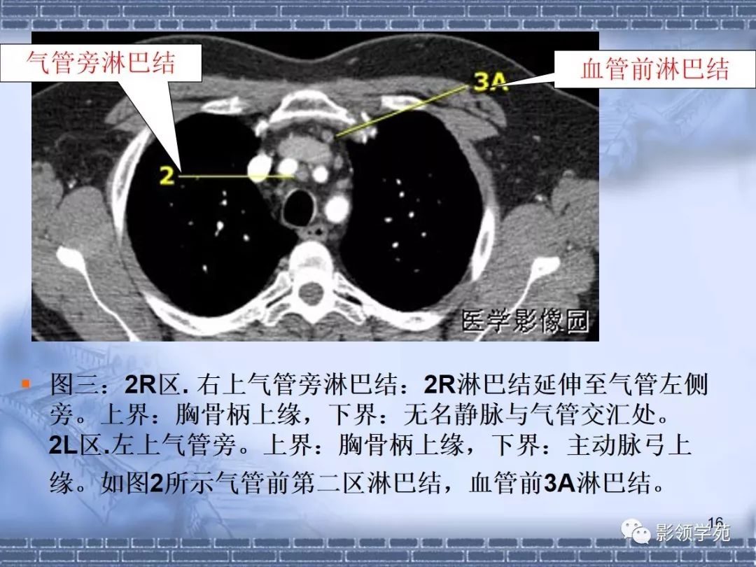 附4 纵隔淋巴结的分组-肿瘤学-医学