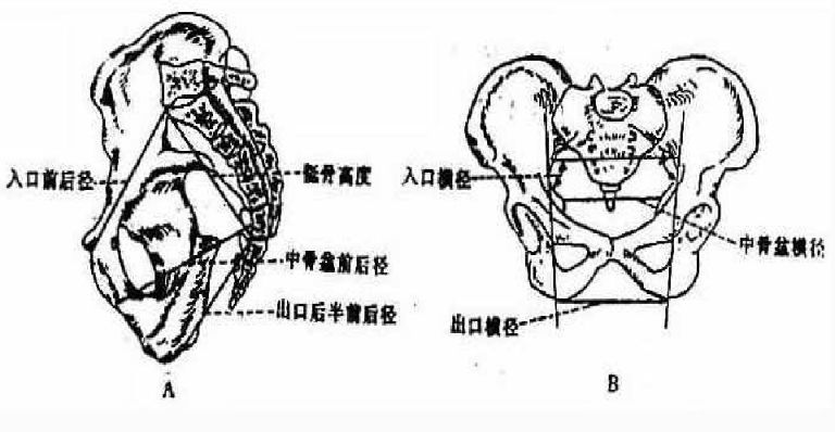 女性盆骨横椭圆形.入口的前后径(真结合径11.