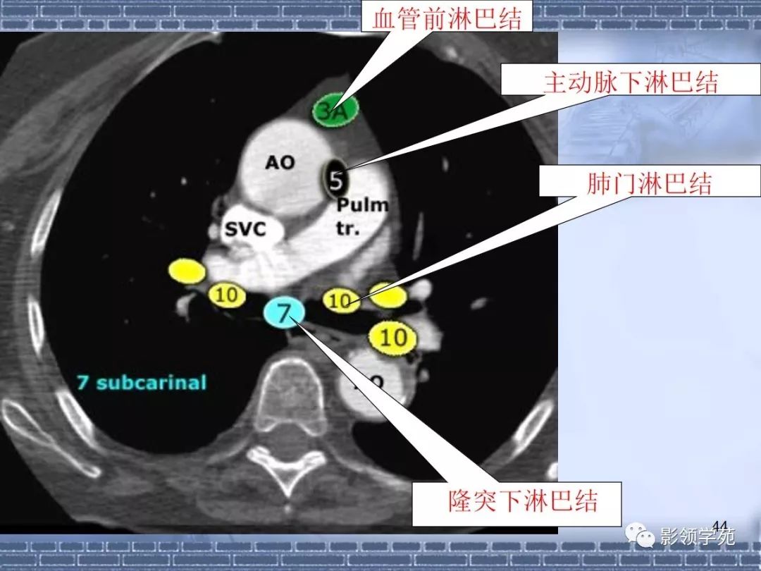 肺癌纵隔淋巴结分区