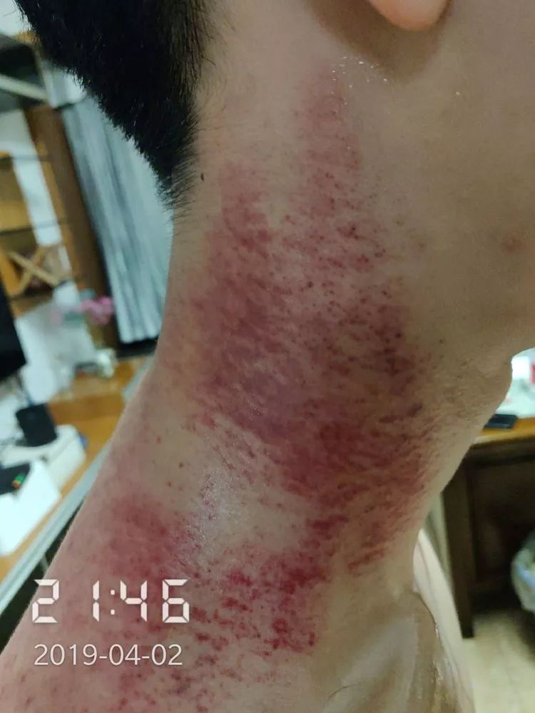 舌苔提示心肝火旺,曲池,劳宫降心火,太溪,复溜补肾水;风邪为阳邪侵犯