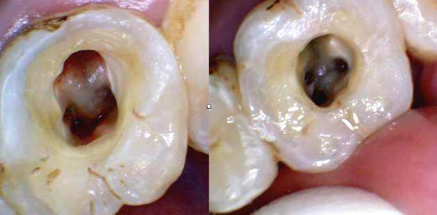 根尖周炎表现为慢性过程为咬合隐痛或不适,波及到牙槽骨可形成齿槽
