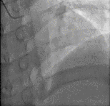 看似简单的心电图,其实暗藏玄机(下)